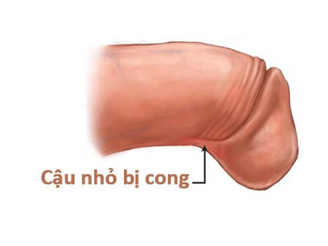 Thế nào là dương vật bị cong?