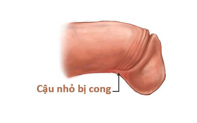 Thế nào là dương vật bị cong?