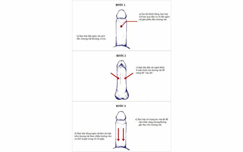 Cách chữa dương vật bị cong với bài tập BACKWARD PULLER