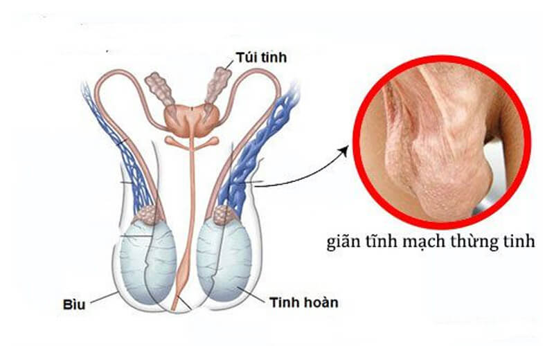 Giãn tĩnh mạch thừng tinh