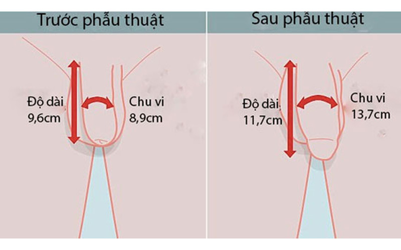 Thực hiện phẫu thuật